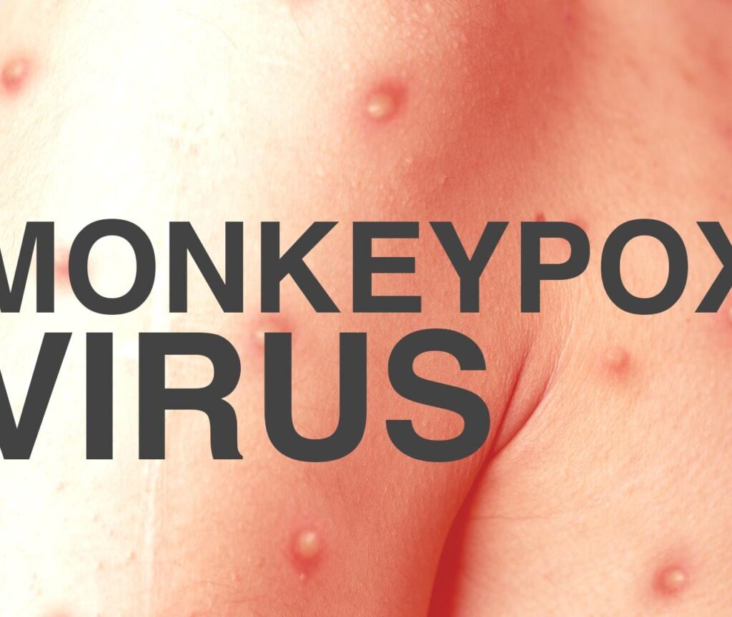 Monkey Pox Virus