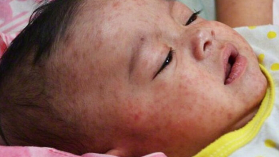 Measles outbreak in Khyber Pakhtunkhwa province