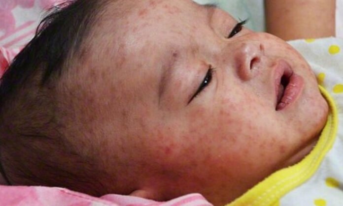 Measles outbreak in Khyber Pakhtunkhwa province